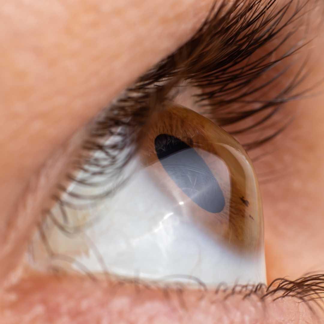 Coçar os olhos pode parecer inofensivo, mas pode comprometer a visão